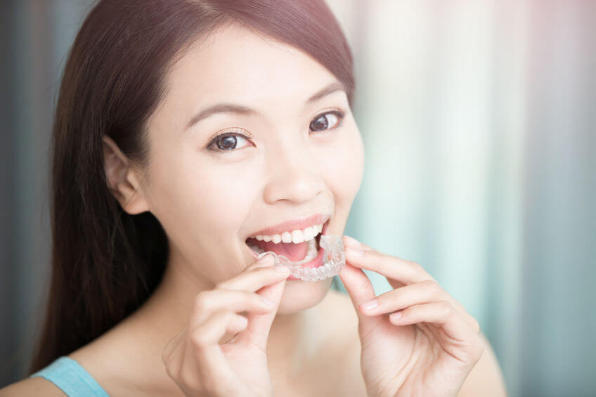 Frau beim Einsetzen der Zahnschiene Knirscherschiene gegen Zähneknirschen